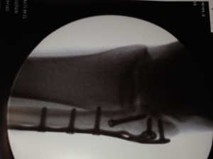 bionic ankle 2