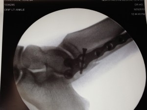 bionic ankle